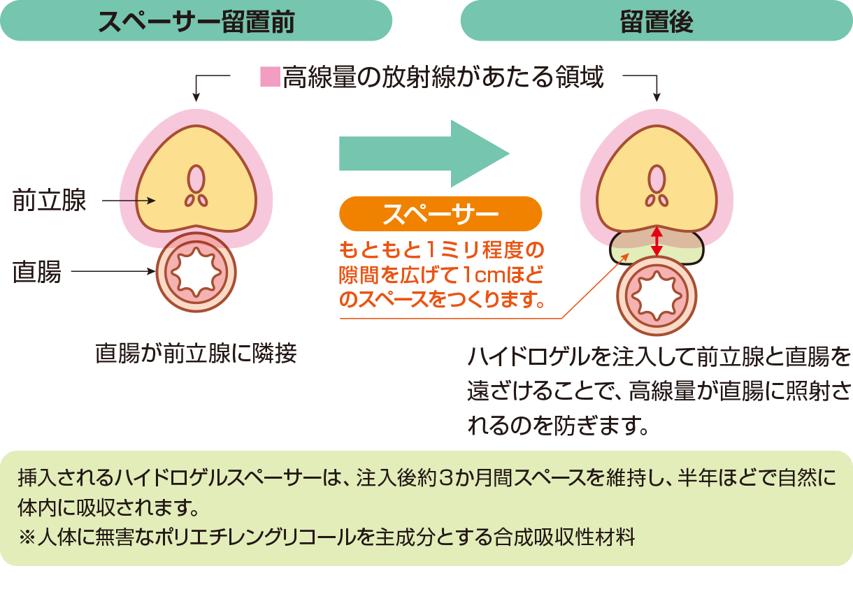 ハイドロゲルスペーサー留置