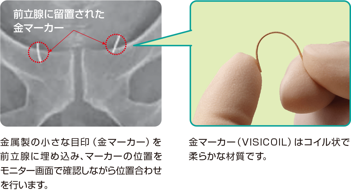 金マーカー留置